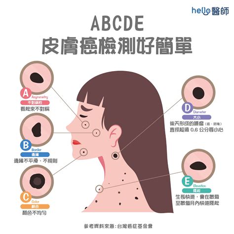 痣長毛代表什麼|痣形成的原因？痣長毛、痣變多變大是痣病變？5招判。